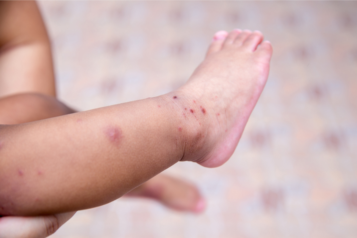Hand, Foot, and Mouth Disease (HFMD)