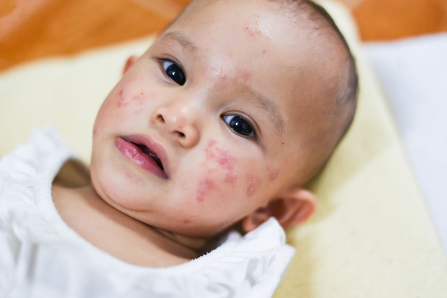 Managing Allergies in Babies: Symptoms and Prevention Tips