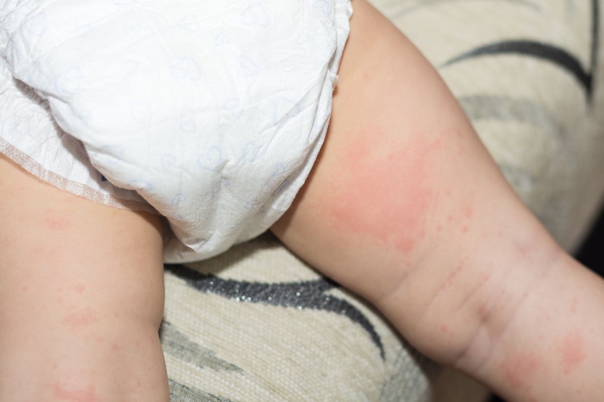 Causes, Symptoms, and Types of Diaper Rash