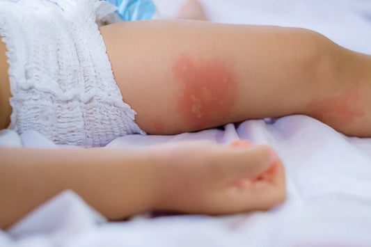 A Comprehensive Guide to Dealing with Diaper Rashes